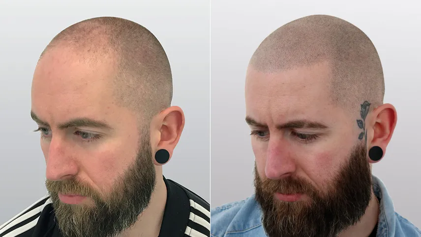SMP Before and After Treatment